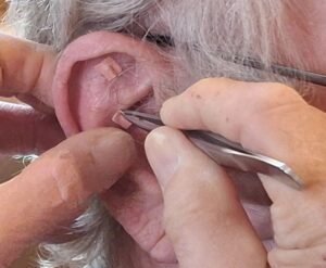 Übergewicht und Adipositas: Ein Blick durch die Linse der Traditionellen Chinesischen Medizin