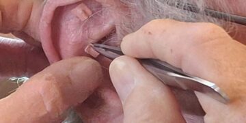 Übergewicht und Adipositas: Ein Blick durch die Linse der Traditionellen Chinesischen Medizin